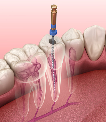 Root Canal Treatment