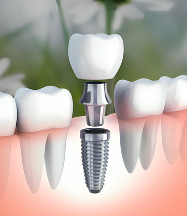 Dental Implants