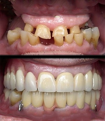 Full Mouth Rehabilitation